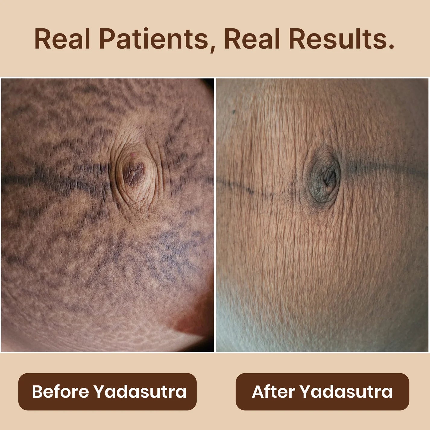 Kikkisa Lepam | Anti-Stretch Marks Cream (100g) - YadaSutra