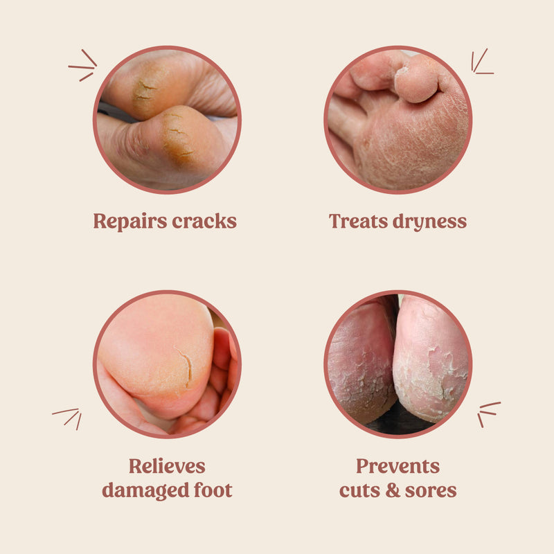 Foot Cream (Treats Cracked Heels) - Vilvah