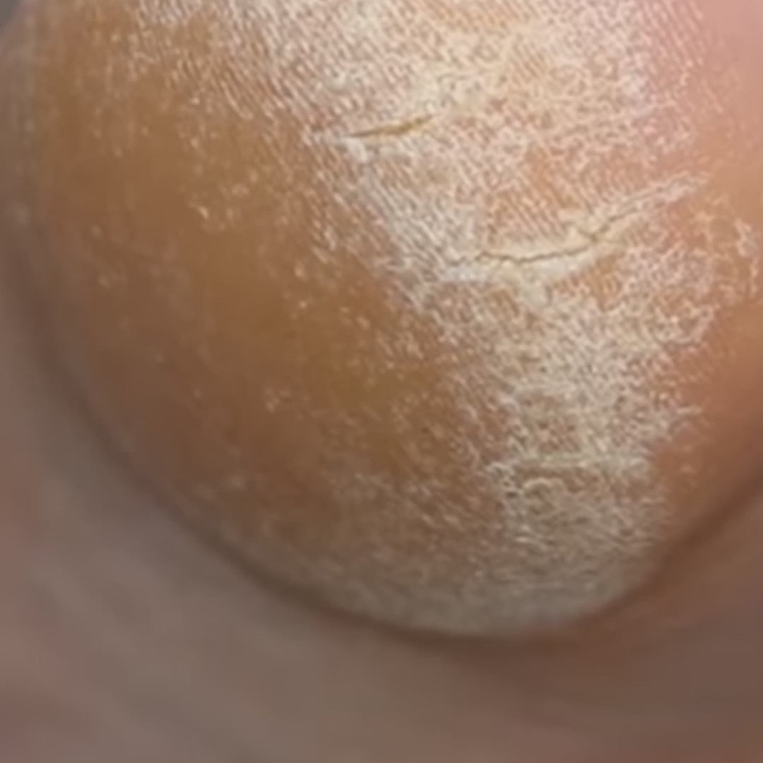 Load video: Foot Cream (Treats Cracked Heels) - Vilvah